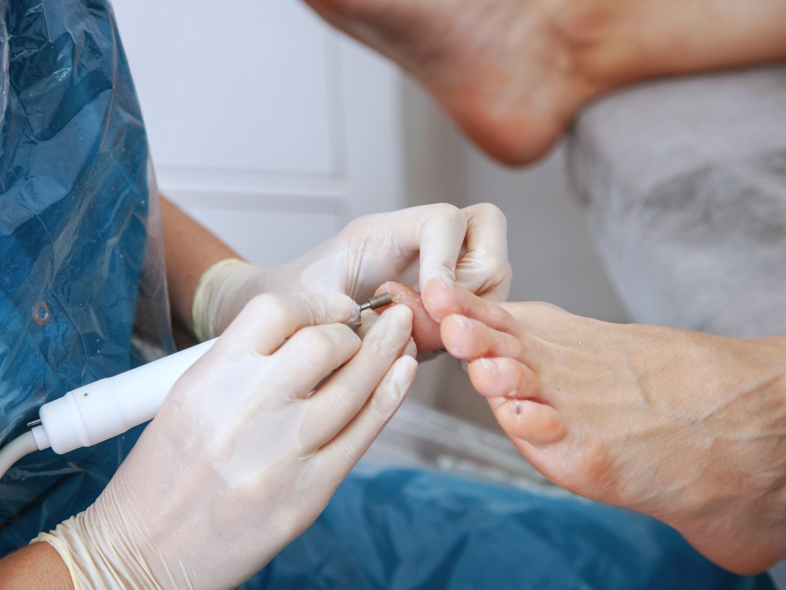 Burr in hand on the foot during a minimally invasive osteotomy